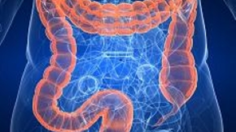 Colorectal Cancer
